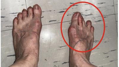 出國爆走一波腳痛爆!「腳底長繭、腳趾凸起」是拇趾外翻前兆