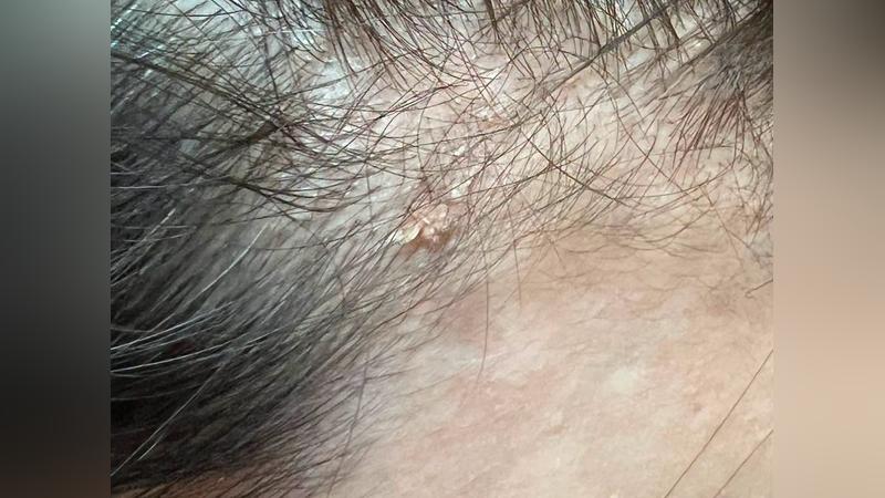 手癢亂摳!40歲女額頭「痘痘變小菜花」 醫示警:痘痘的復仇