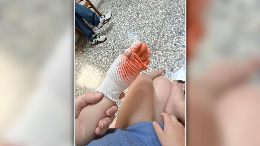 公園鐵板變煎板?控兒手腳遭燙傷起水泡 2週才痊癒。(圖/民眾提供)