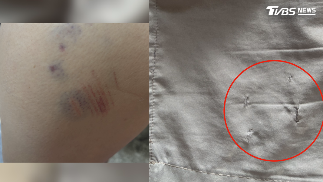江姓女子大腿上出現一大片瘀青及擦傷痕跡,當時穿著的運動短褲更被大狗直接撕咬破裂。(圖/TVBS)