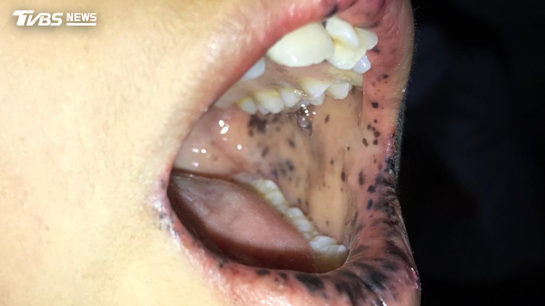 嘴冒黑點恐變大腸癌!「1疾病」息肉狂長