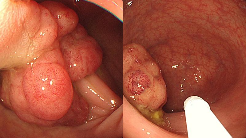 無症狀竟藏癌!6旬男腸內塞「10多顆息肉」 醫曝:險切半邊大腸