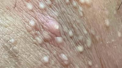 以為得性病!男下體布滿黃顆粒狂擠爆血 醫笑:皮脂腺長錯地方