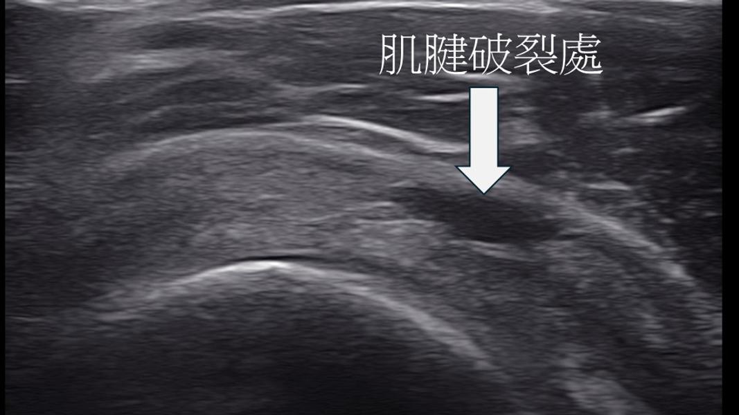 肌肉骨骼超音波顯示旋轉肌肌腱撕裂。(圖/祐禾復健科診所院長羅嘉元提供)