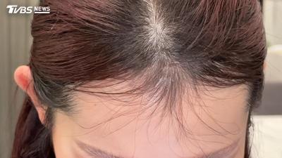女性罹紅斑性狼瘡是男性7倍!醫師:出現「這5大症狀」別只當過敏
