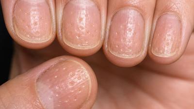 指甲出現「密麻小凹洞」別盲信缺鈣 醫示警:免疫系統拉警報