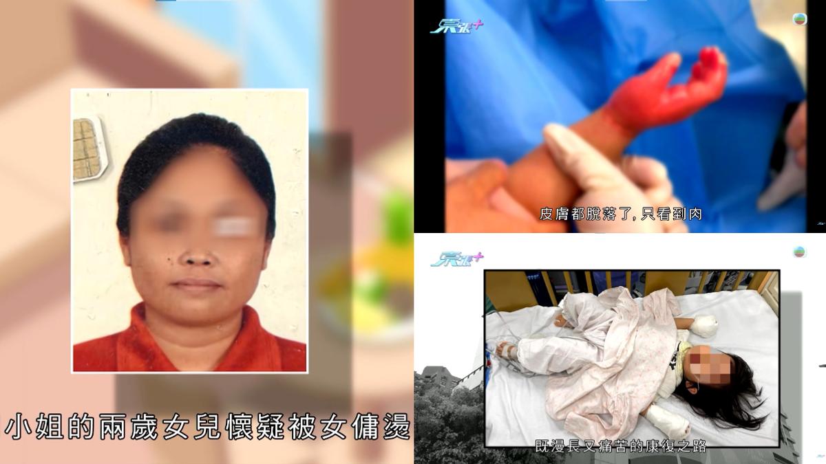 2歲童遭燙傷脫皮滿手血!狠心女傭說詞反覆遭捕