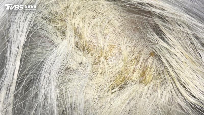 一秒變阿桑!妙齡女漂髮頭皮爛掉慘禿 醫:這染劑當心