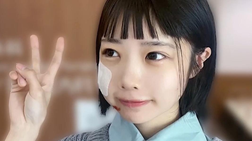 ano節目中曬出當時照片,還稱之後臉還變得更腫。(圖/翻攝自hoeruyoru_ntv推特)