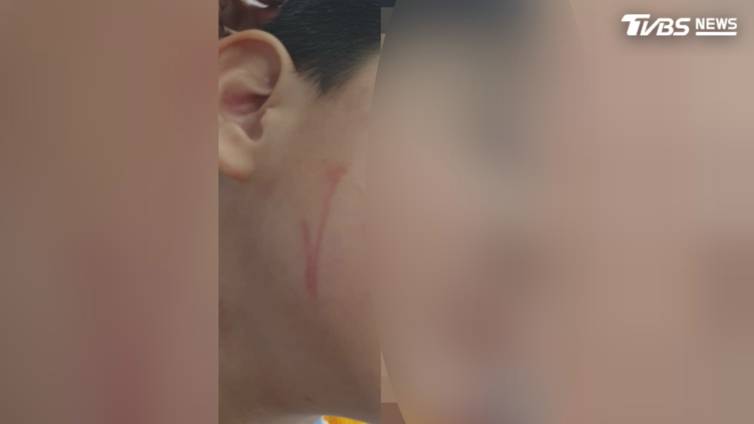 4歲孩子去年底在高雄一處幼兒園遭到老師施暴,不只臉上留下多道抓痕,連身體也有多處擦挫傷(圖/TVBS)