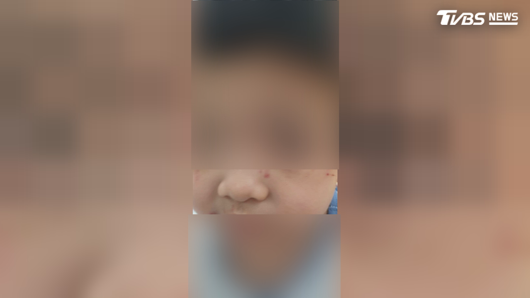 臉部十幾個傷口以外,孩子的嘴巴裡面還有血腫及挫傷,頸部也有一個紅色疑似掐痕,臉上更有很深的刮傷(圖/TVBS)