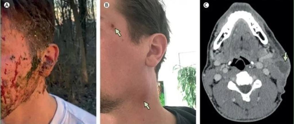 患者受傷當日的情況(A);數週後出現臉部損傷和頸部腫脹(B);事故發生一個月後,CT掃描顯示該男子臉部一側有膿腫。 (Gruell et al., Lancet Infect. Dis. , 2026)