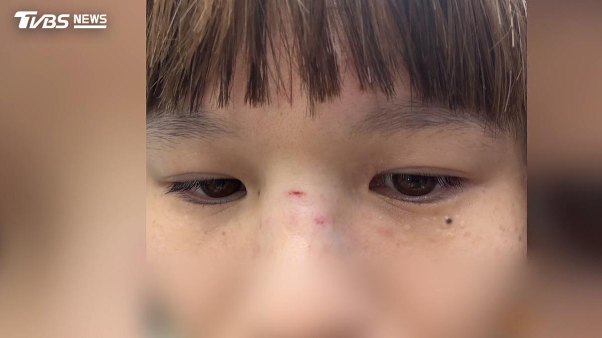 長照居服員遭個案「木椅砸臉」鼻骨骨折 疑案母擅停兒子藥物釀禍