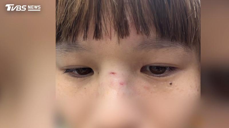 長照居服員遭個案「木椅砸臉」鼻骨骨折(圖/TVBS)