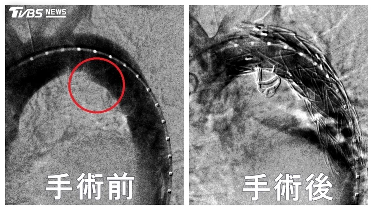 耳鼻喉名醫開車突胸痛!一照「主動脈潰傷」 急裝支架搶命