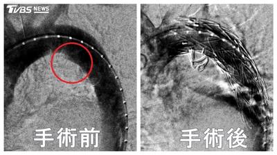 耳鼻喉名醫開車突胸痛!一照「主動脈潰傷」 急裝支架搶命