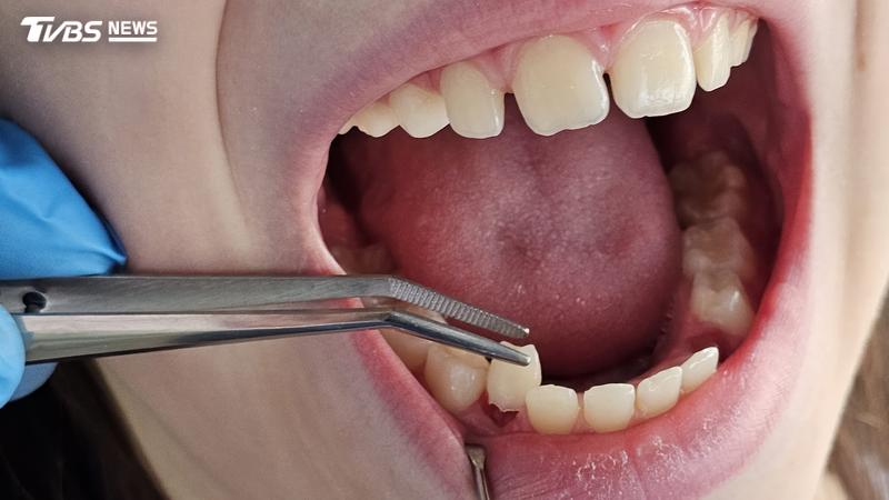 許多人會擔心拔牙後的不適與發炎問題。(示意圖/Shutterstock達志影像)