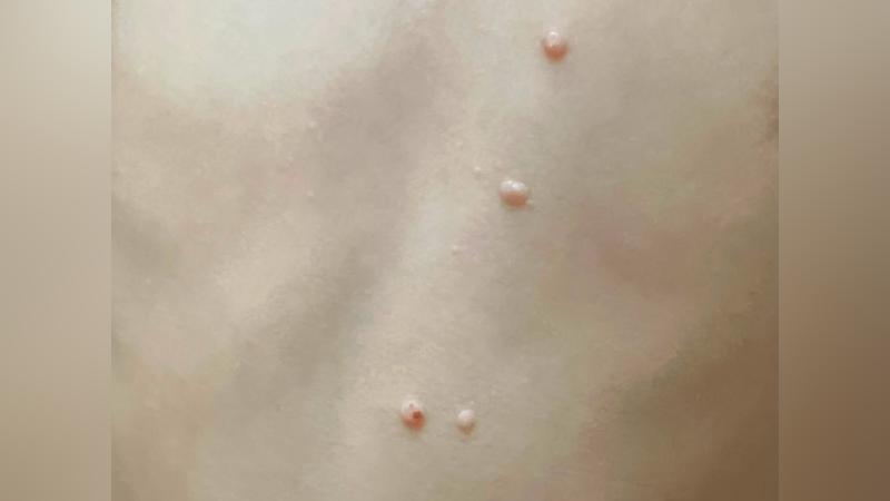 傳染性軟疣-傳染性軟疣是什麼-傳染性軟疣病毒-傳染性軟疣原因-傳染性軟疣治療過程-傳染性軟疣治療-傳染性軟疣多久會好-傳染性軟疣一直長-傳染性軟疣兒童-吳仁欽