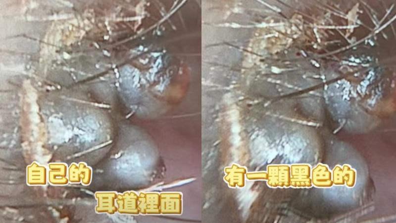 呂弘鈞醫師提醒,耳道內若發現不明腫塊,應交由專業醫師處理。(圖/翻攝自呂弘鈞醫師臉書)