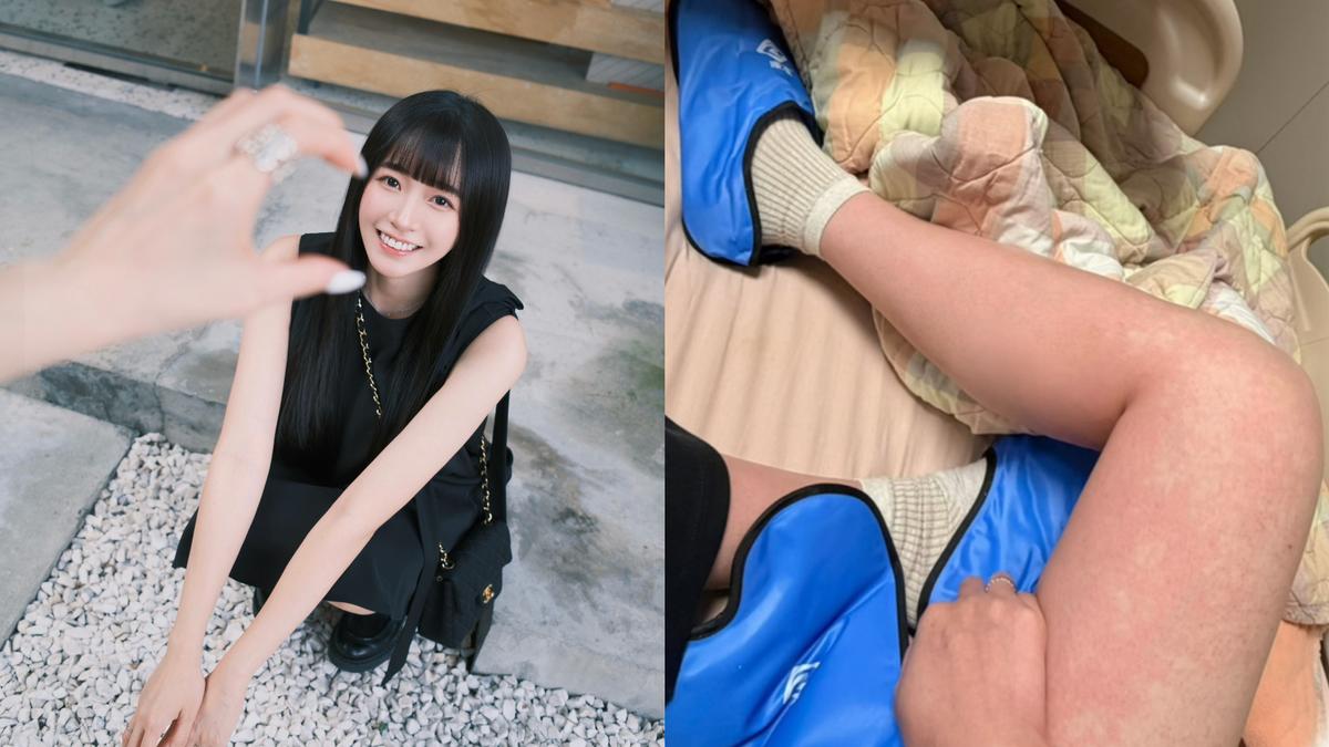 語謙罹乳癌二期!首次化療爆嚴重過敏「大腿腫一片」急中斷