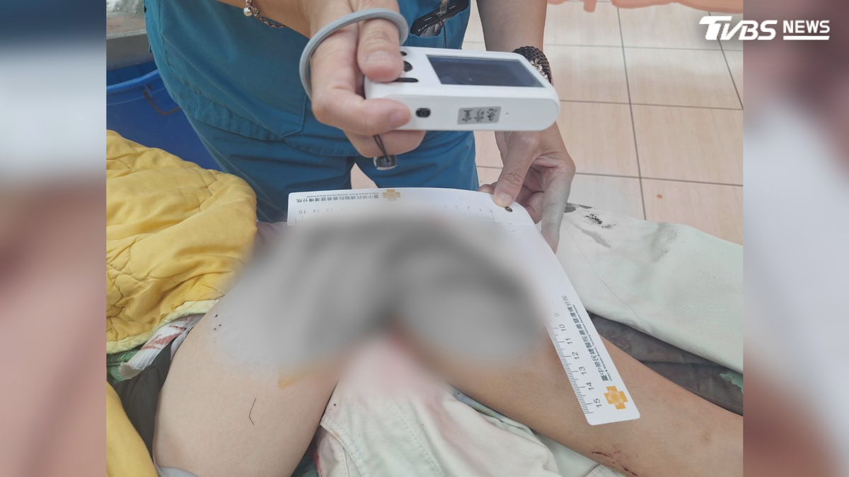 國一生踩破水溝蓋 腿遭鐵條刺穿縫17針