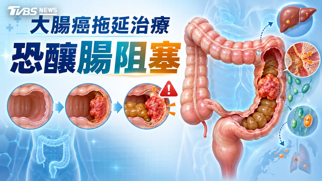 罹「這癌症」 別逃避!醫揭拖延治療恐腸阻塞、錯失治癒機會(圖/TVBS)
