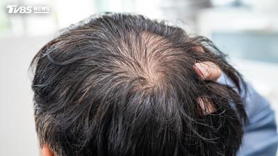 37歲男掉髮、M型髮線!以為遺傳雄性禿 醫揪「缺鋅」6週恢復