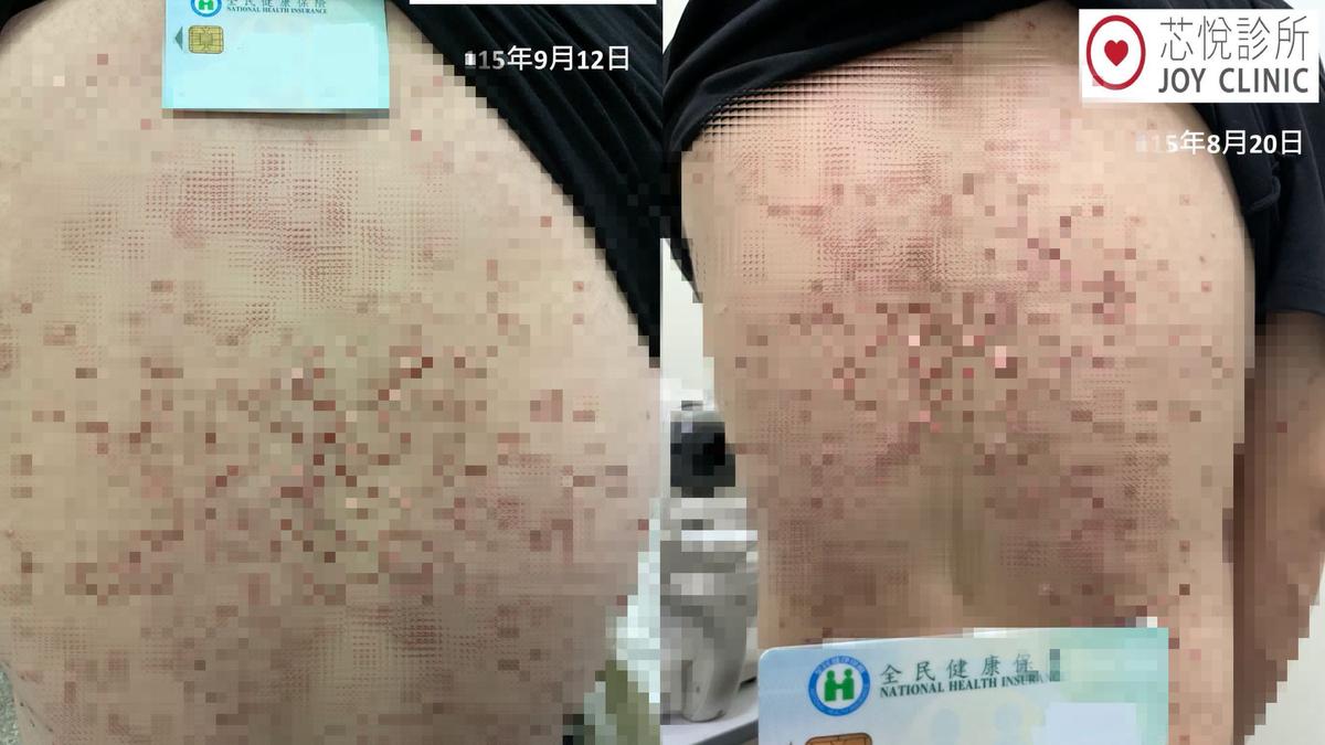 23歲男全身長滿黃色瘤!抽血查三酸甘油脂破6000 胰臟險壞死