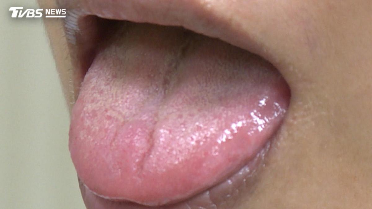 舌苔厚就是濕氣重?醫師揭看舌頭重點 若有異常要注意!