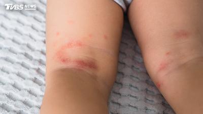 1歲前狂抓「得1病」!醫示警:恐引爆氣喘、過敏