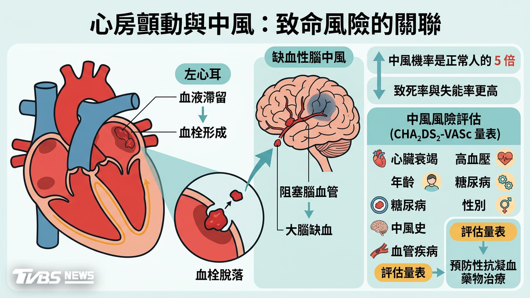 心房顫動恐增中風5倍! AI精準診斷搭配新式電燒治療一次看(圖/TVBS)