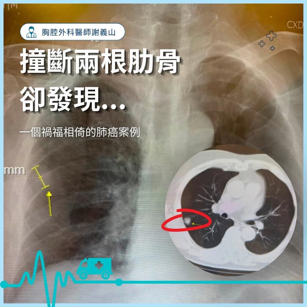 60幾歲患者因撞斷肋骨,意外發現得了肺腺癌。(圖/謝義山醫師提供)