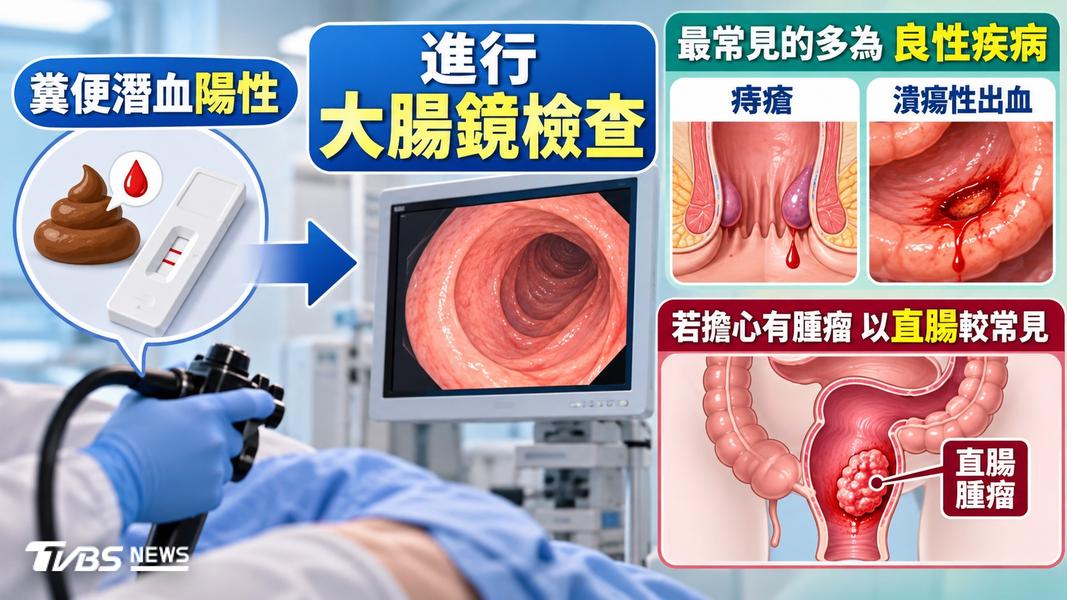 直腸癌一定要人工肛門嗎?醫:完全新輔助治療爭取保肛機會(圖/TVBS)