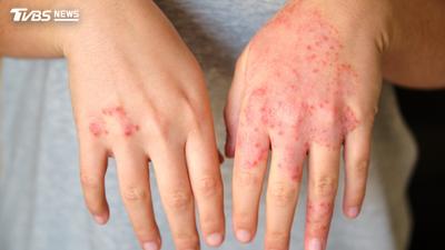 便祕冒痘濕疹狂炸!中醫揭「腸道求救訊號」:4招神逆轉發炎