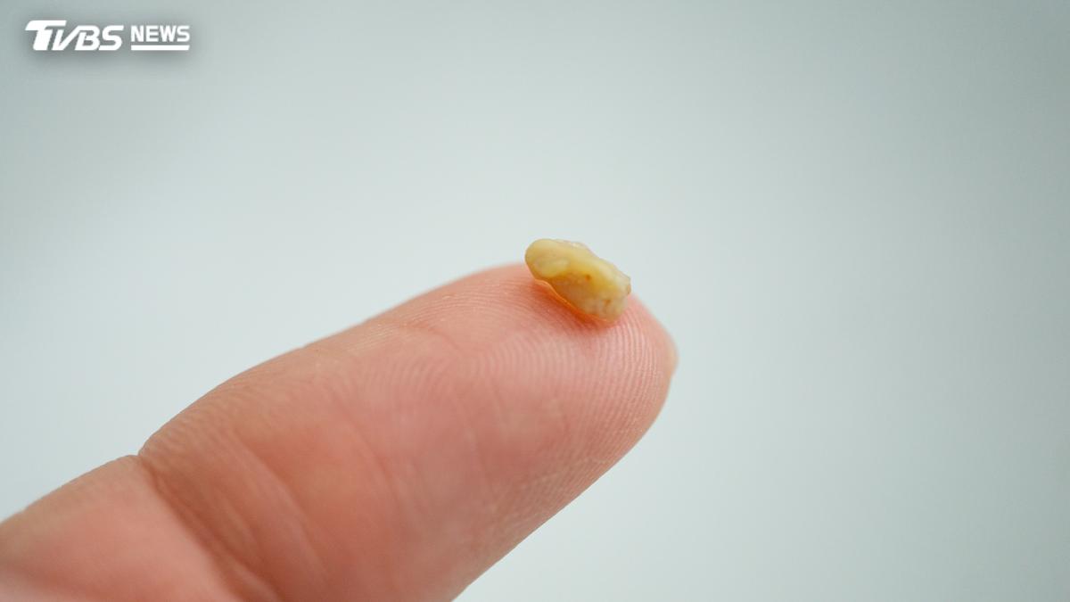 喉嚨痛3週+飄腐爛臭!婦人嚇問AI「不是癌就是壞死」 醫揪真兇