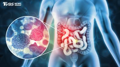 大腸癌年輕化!診斷罹癌常已3、4期 常見「4症狀」快就醫