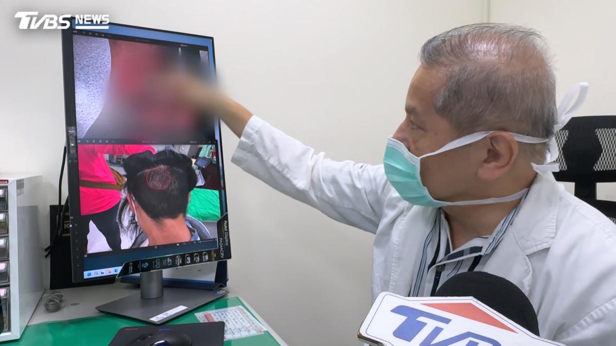 25歲女營養師腳踝遭排氣管「燙到皮膚壞死」!靠自體頭皮移植 3週傷口癒合