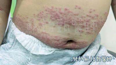 酒精殺不死腸病毒!4歲童狂冒「豪邁水泡」 醫點這特徵:沒發燒