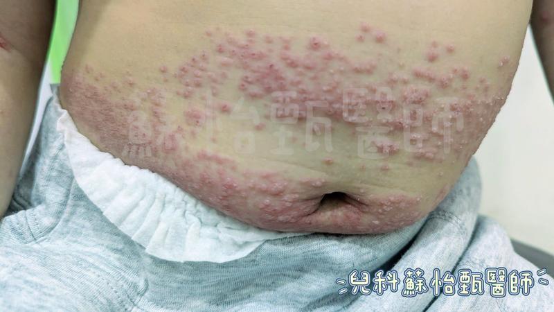 腸病毒-腸病毒症狀-腸病毒初期症狀-腸病毒傳染-腸病毒疹子