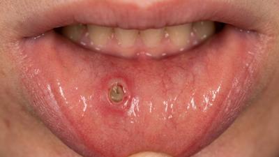不是火氣大!醫揭「3常見藥物」恐害嘴破:超過2週小心是癌