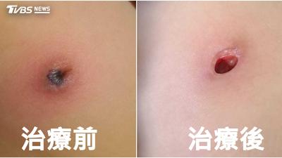 國小女童發燒乳頭紅腫!綠膿桿菌感染「右乳被吃光」 醫揭原因