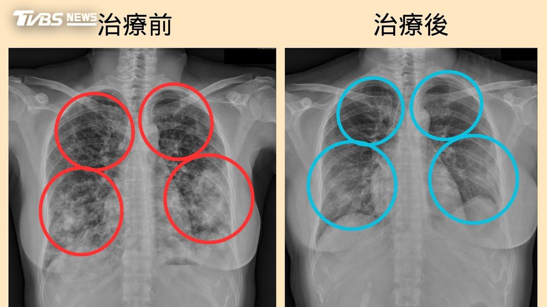 大千醫院-苗栗-肺癌-年輕女