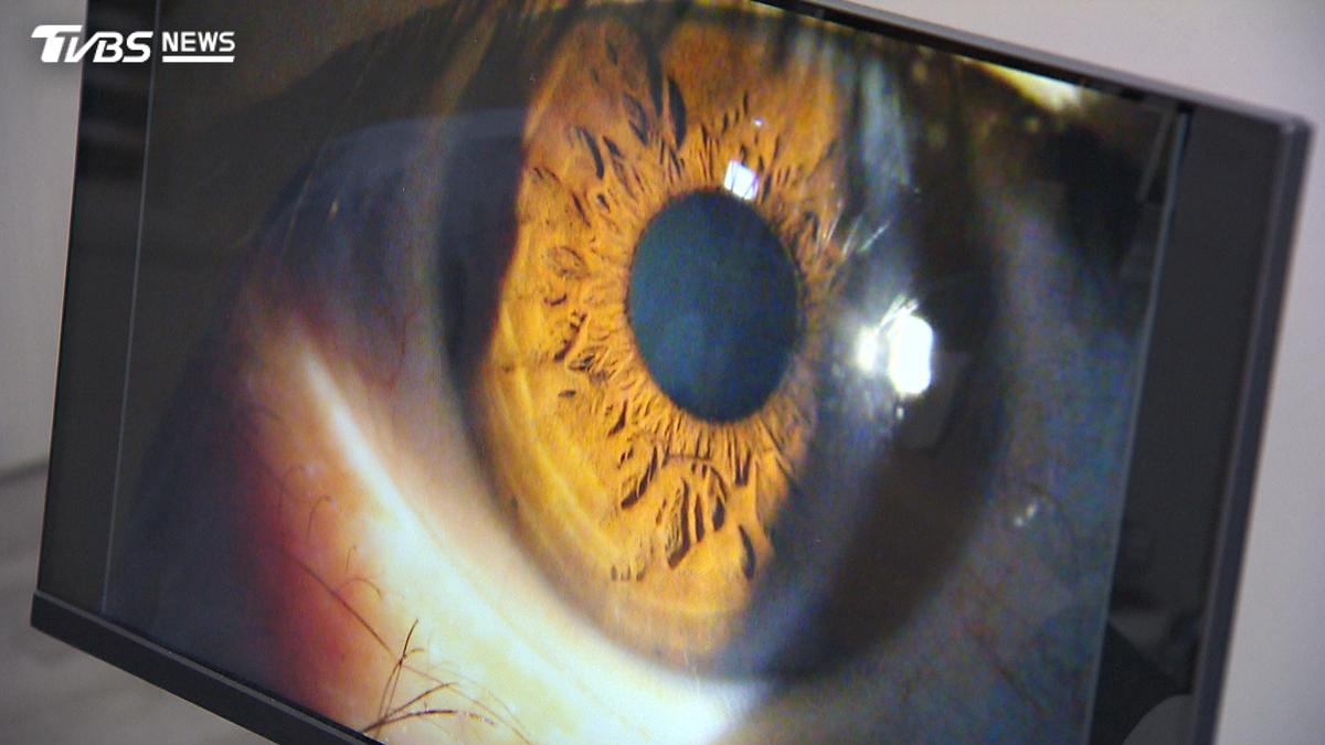 眼睛劇痛又想吐?隅角閉鎖型青光眼急性發作警訊一次看