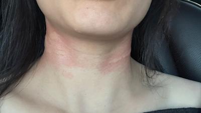 影音/南寮漁港風箏線纏脖「勒出紅腫痕」 女受傷討公道反遭比中指