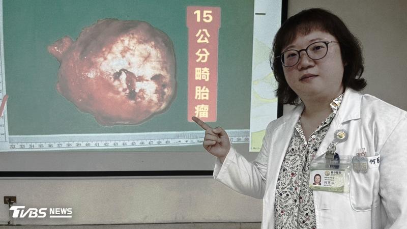 台中24歲女子做健檢,在胸腔發現超巨瘤。(圖/台中醫院提供)