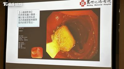 以為會隨糞便排出 8旬翁假牙吞下肚「竟卡在小腸」險穿孔