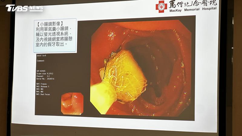 8旬老翁假牙卡肚子2個月,最後才取用小腸鏡取出。(圖/陳詩璧攝)