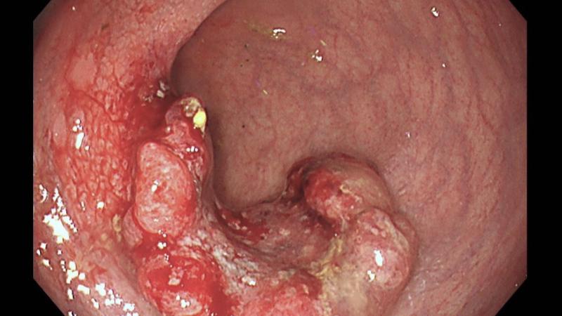 患者檢查發現直腸腫瘤。(圖/醫院提供)