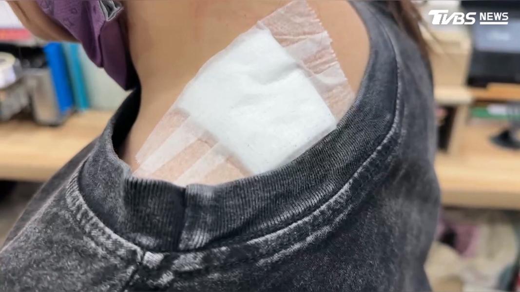做飲料的老闆娘,左側頸部被燙傷、起水泡,頭髮還燒焦(圖/TVBS)