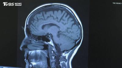 額顳葉失智症不一定先健忘!個性突變、衝動失控及語言障礙要留意